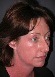 Mid Facelift - Patient 3 - Obl Right - After